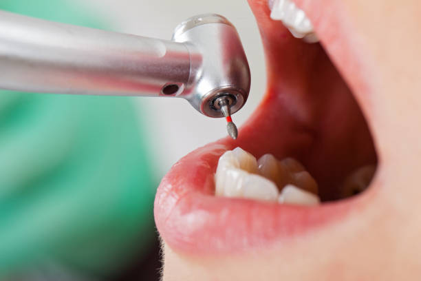 Best Emergency Dental Care for Broken or Chipped Teeth in Dover, TN
